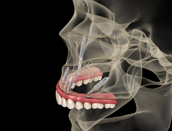 Maxillary prosthesis supported by zygomatic implants at North Hills Implant & Oral Surgery in Raleigh, NC