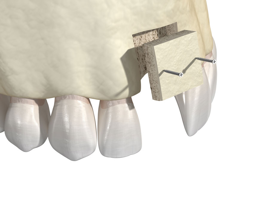 Bone grafting - augmentation using a block of bone, tooth implantation. Medically accurate 3D illustration  at North Hills Implant & Oral Surgery in Raleigh, NC 27609-6518