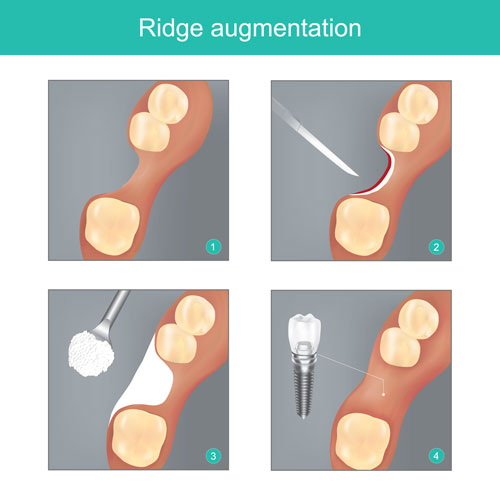 Ridge augmentation. The method dental used materials synthetic or human bone for Replace the Jawbone In missing, and to Prepare dental implant work to next step