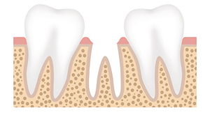 Graphic of missing tooth at North Hills Implant & Oral Surgery in Raleigh, NC