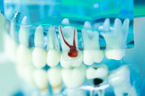  Translucent model of teeth showing red roots of a decaying tooth