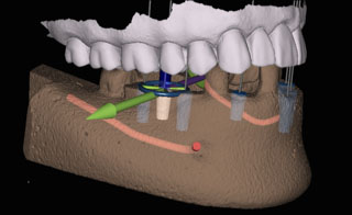 3D image of Guided Implant Placement