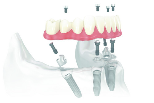 Illustration of All-on-4® Treatment Concept