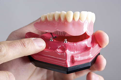 Implant Supported Dentures Diagram at North Hills Implant & Oral Surgery in Raleigh, NC
